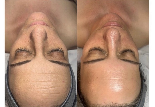 before and after hydrafacial picture from Embody Medspa