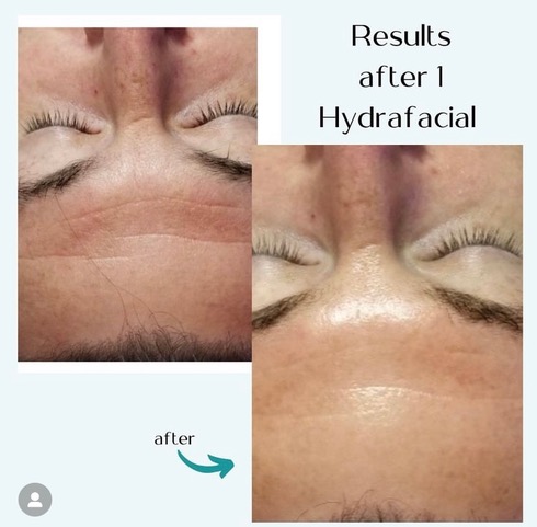 before and after hydrafacial picture from Embody Medspa